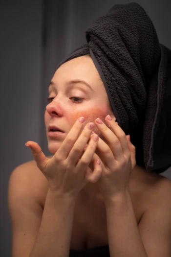 Rosacea