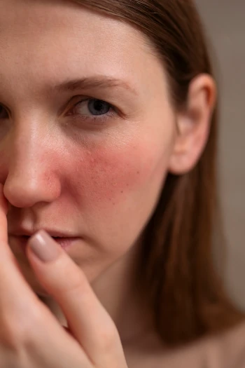 Rosacea