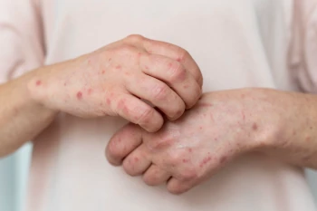 Nurturing Skin Health: Eczema