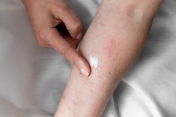 Nurturing Skin Health: Eczema