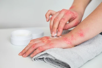 Psoriasis